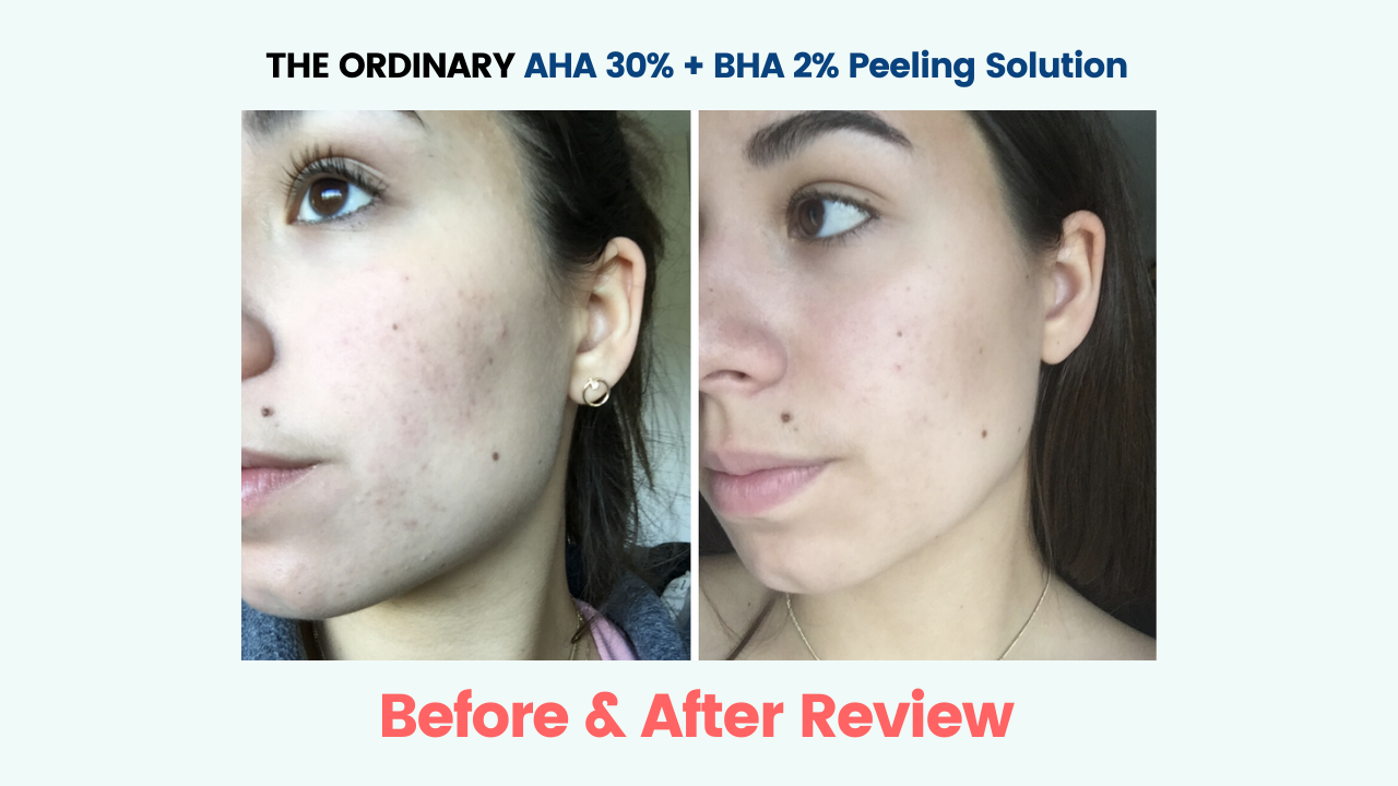 THE ORDINARY™ AHA 30% + BHA 2% Peeling Solution