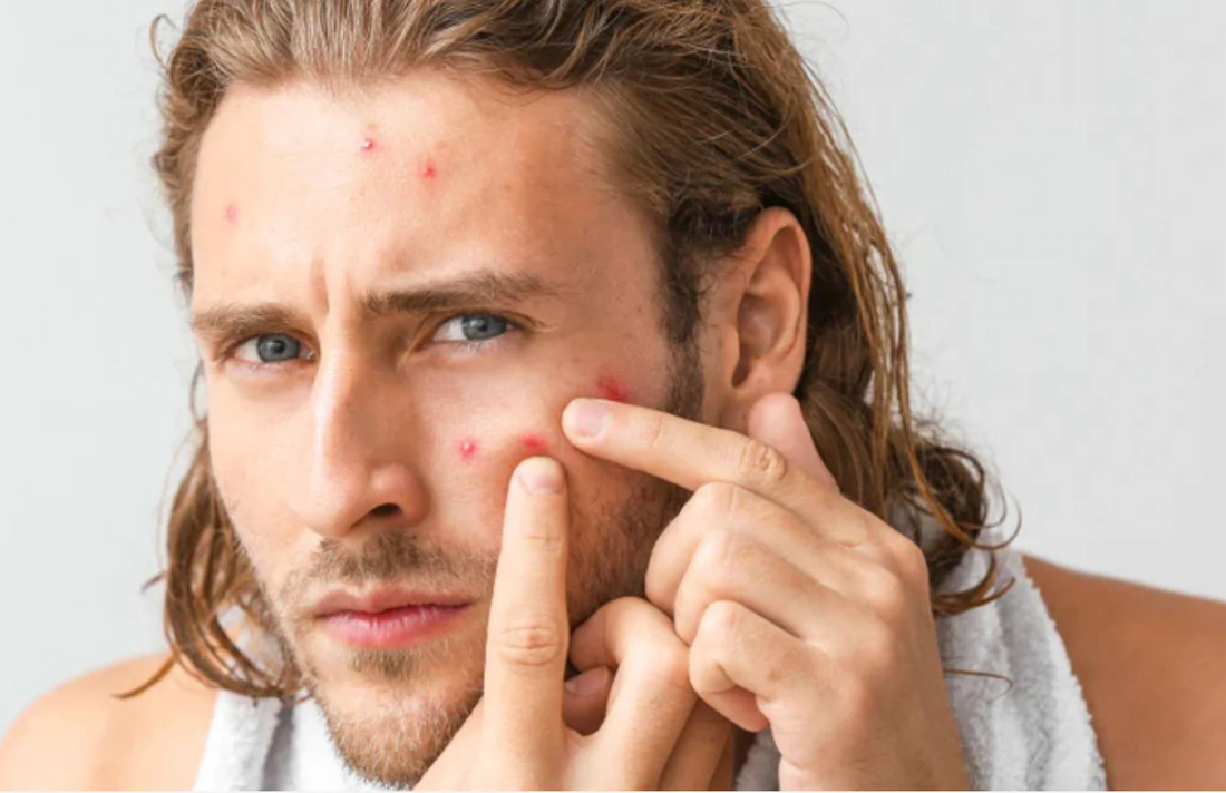 AT WHAT AGE DOES YOUR ACNE GO AWAY? HOW LONG IT TAKES